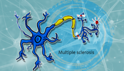 Multiple-sclerosis التصلب اللويحي