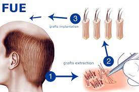 زراعة الشعر بتقنية الاقتطاف  (FUE)