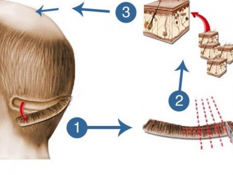 عملية زراعة الشعر بتقنية الشريحة (FUT)