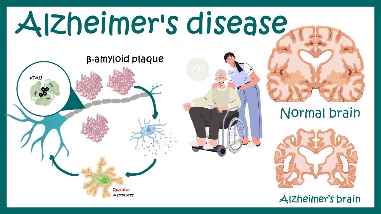 مرض الزهايمر Alzheimer