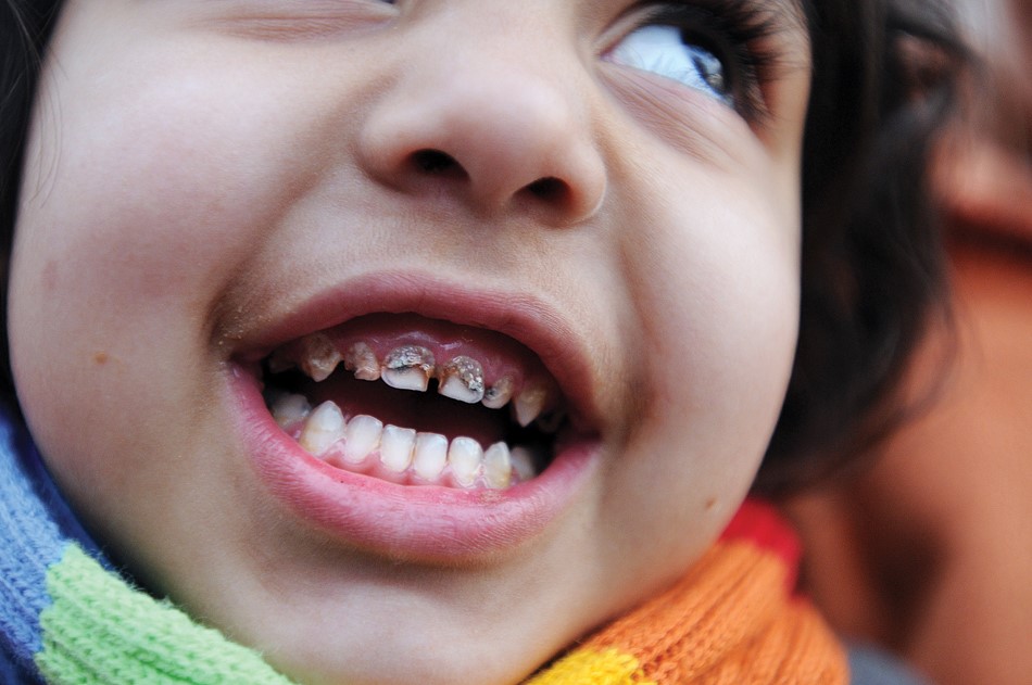 تسوس الأسنان اللبنية عند الأطفال