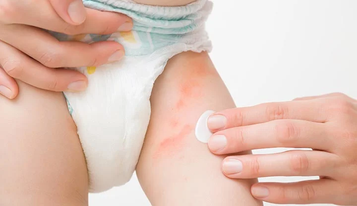  التهاب الحفاضات للأطفال diapers rash