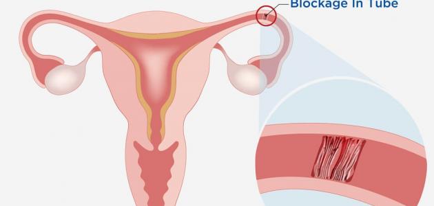 أين تذهب البويضة في حالة انسداد قناة فالوب 