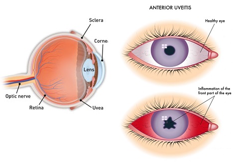 التهاب القزحية والتهاب العين