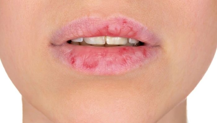 جفاف وتشقق الشفاه