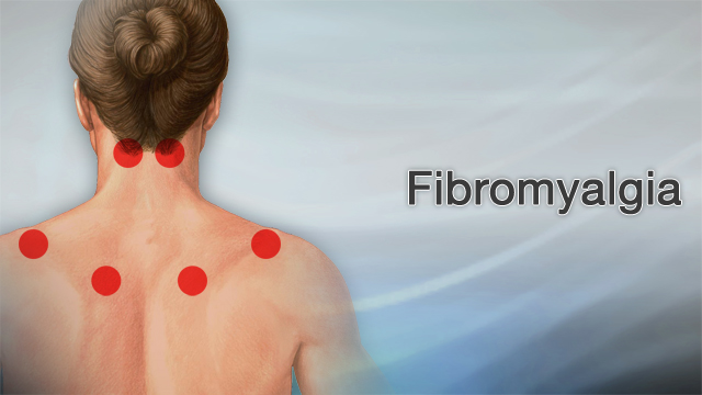 الفايبروميالجيا متلازمة الألم العضلي الليفي