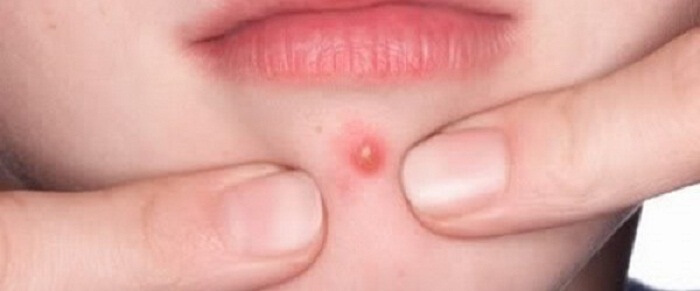 هل تختفي الدمامل من نفسها