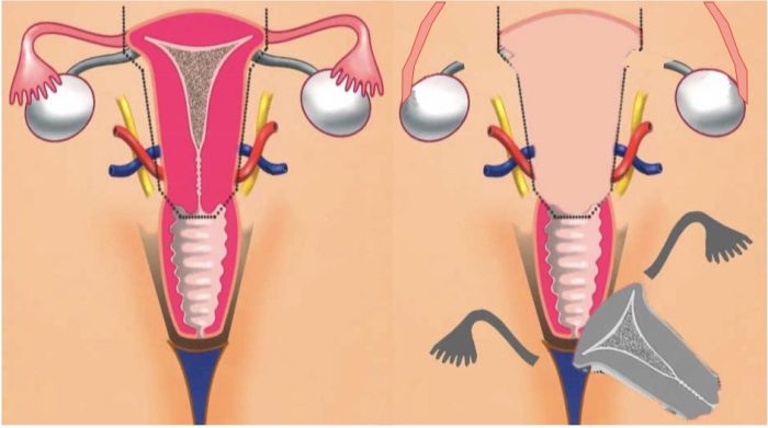 استئصال الرحم