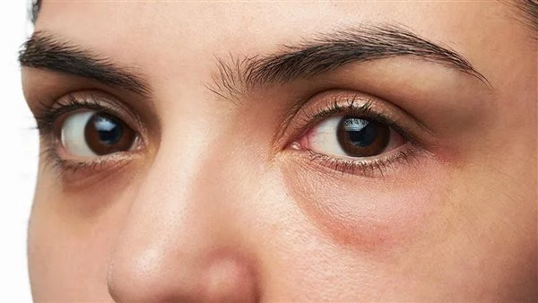 علاج نقص الكولاجين تحت العين